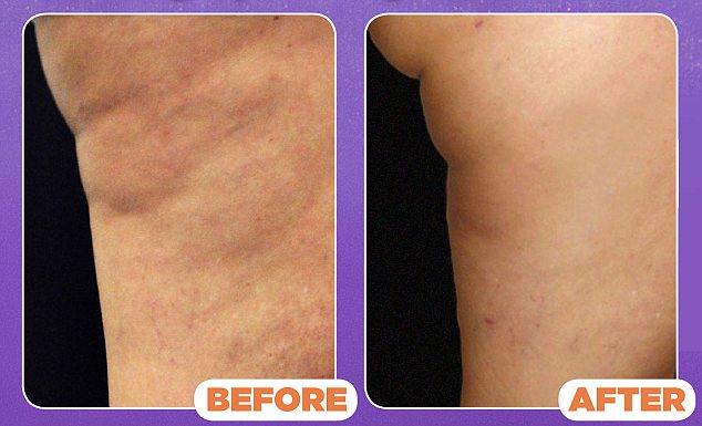 Surgery to remove cellulite usually leaves scarring and an ...